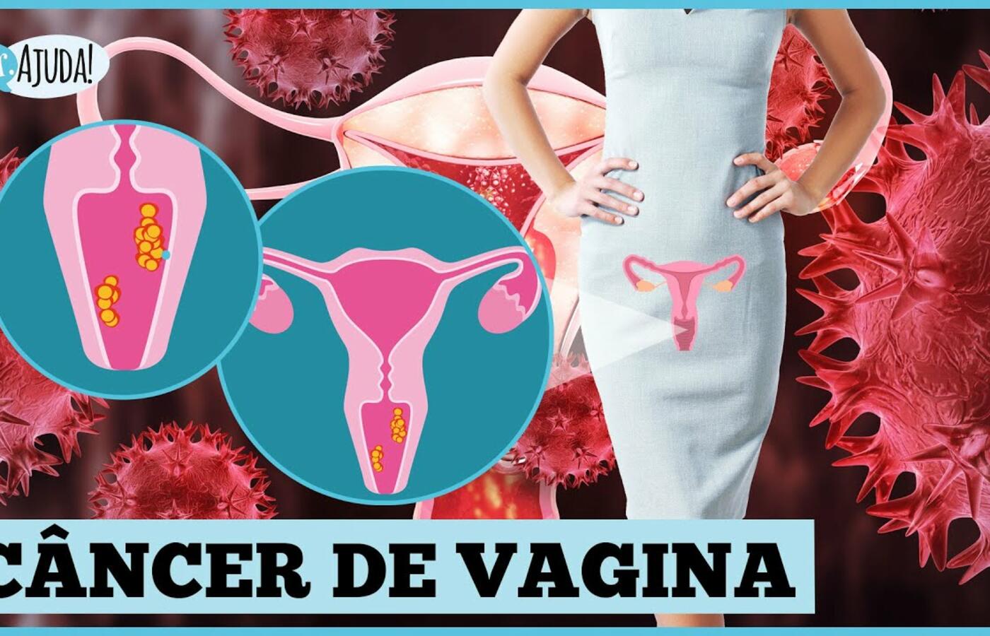 Câncer de Vagina: Sintomas, Fatores de Risco e Diagnóstico Avançado 🩺🔍