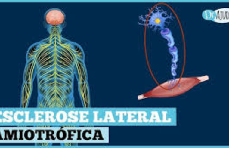 Esclerose Lateral Amiotrófica: sintomas e diagnóstico precoce