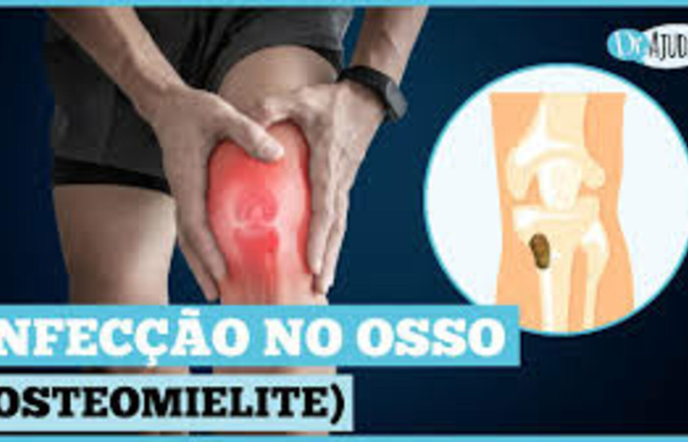 Osteomielite: causas, sintomas e prevenção dessa infecção óssea